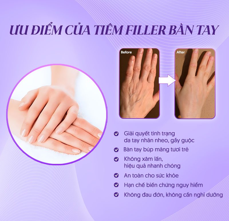 bảng giá tiêm filler ngón Tay