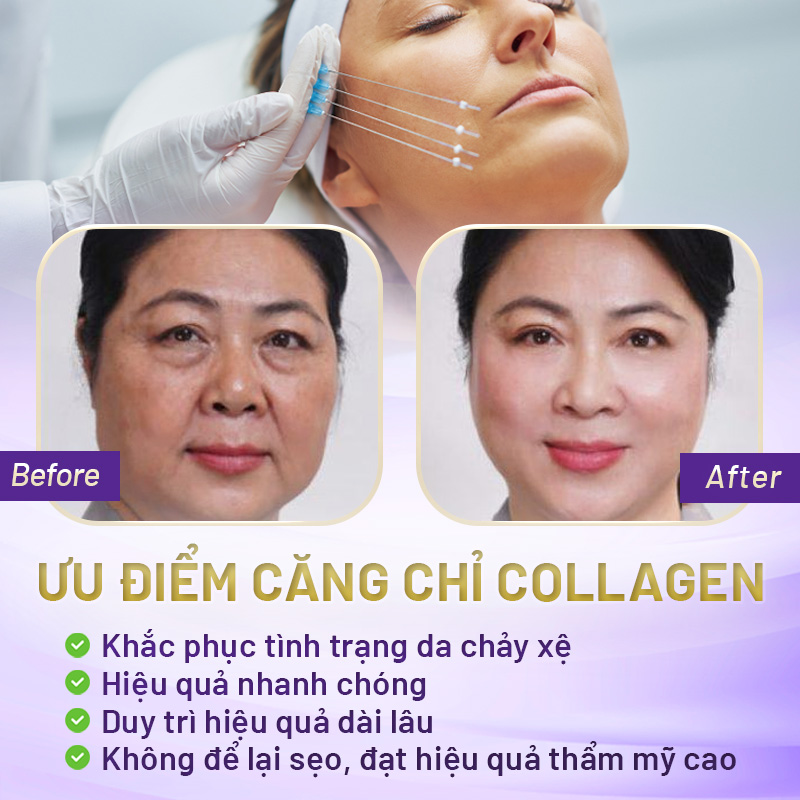căng da mặt collagen hết bao nhiêu tiền
