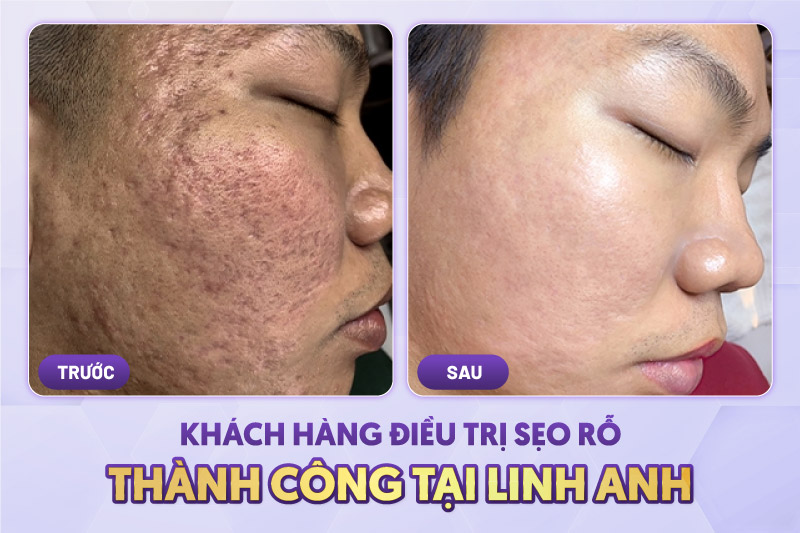 cắt đáy sẹo rỗ bao nhiêu tiền