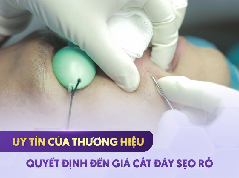 cắt đáy sẹo rỗ bao nhiêu cắt đáy sẹo rỗ bao nhiêu