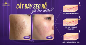cắt đáy sẹo rỗ giá bao nhiêu
