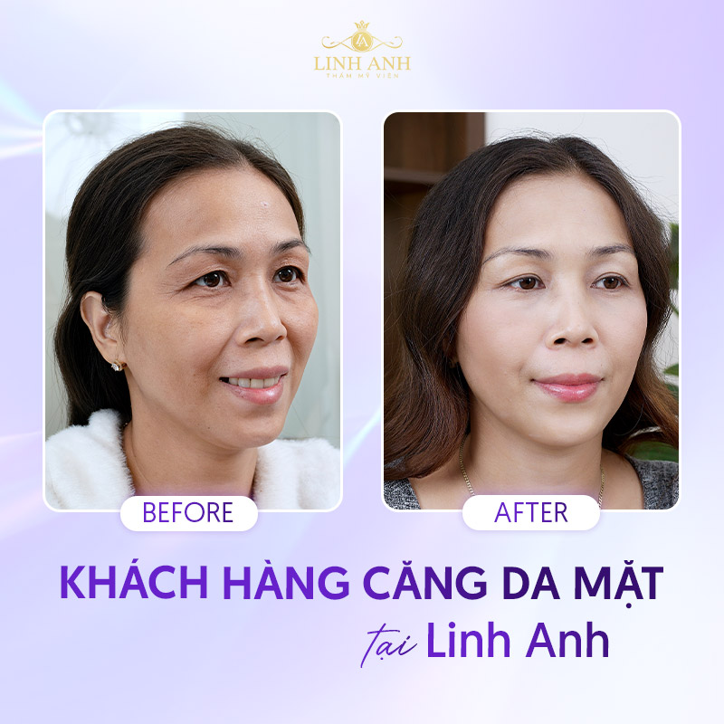 chi phí Căng da mặt