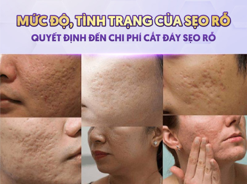 chi phí điều trị cắt đáy sẹo rỗ