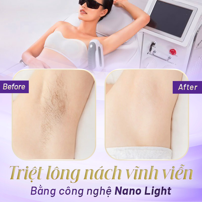 có thể triệt lông vĩnh viễn không