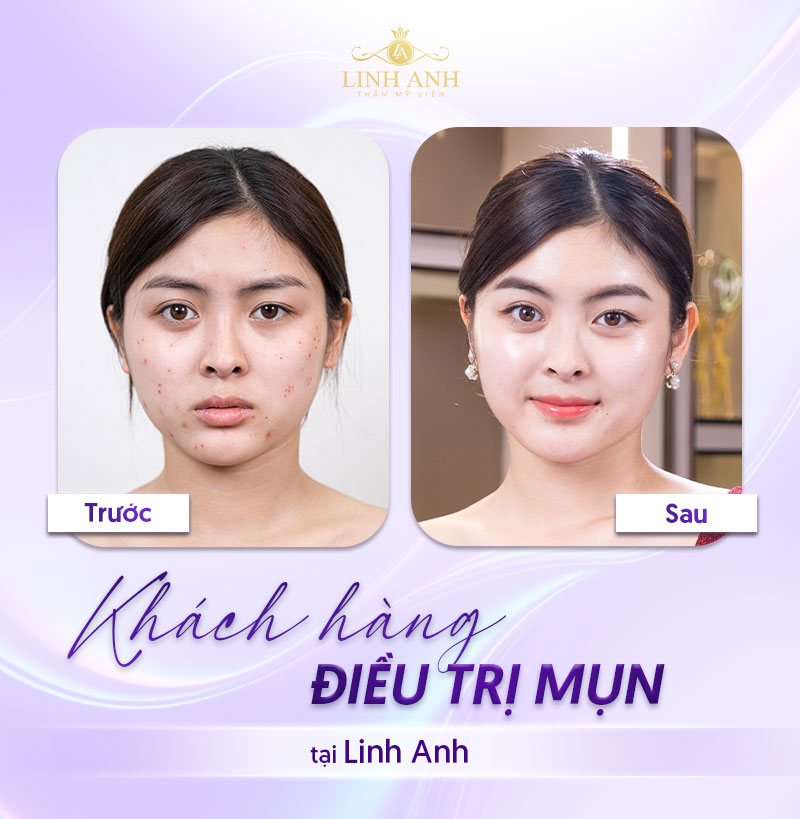 đi da liễu trị Mụn tốn bao nhiêu tiền đi da liễu trị Mụn tốn bao nhiêu tiền