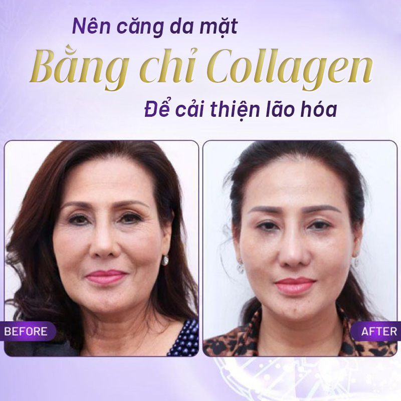 giá căng chỉ collagen