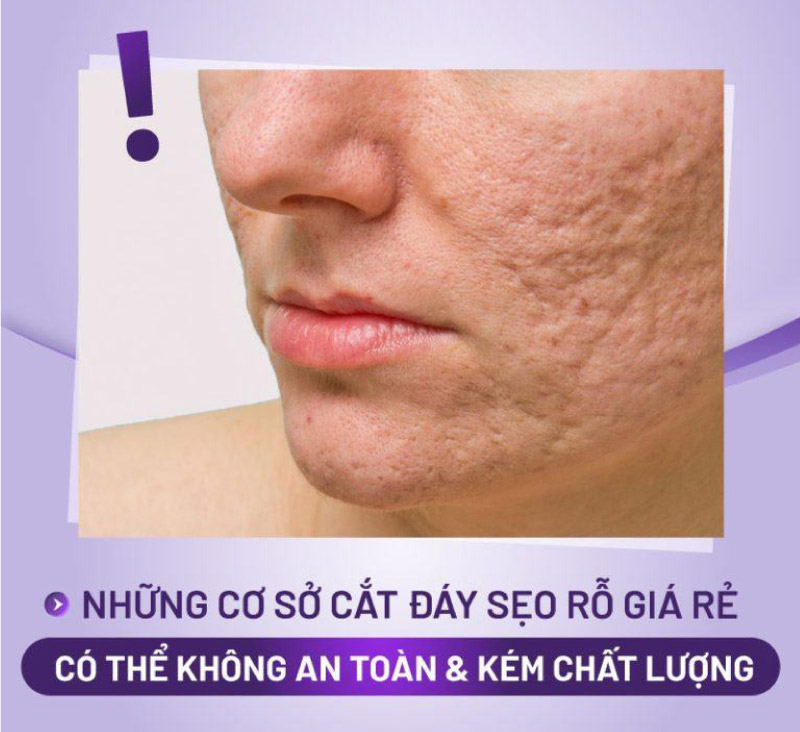giá cắt đáy sẹo rỗ