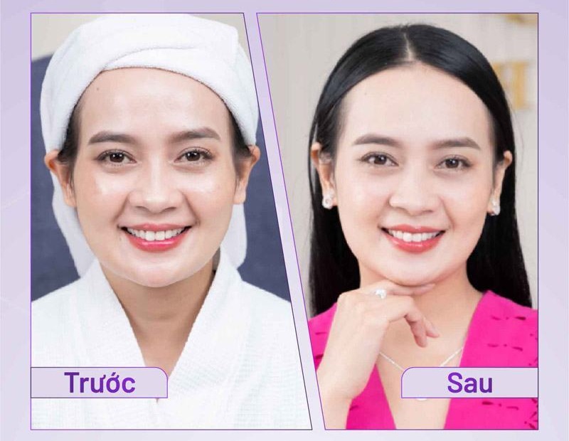 Hình ảnh trước và sau khi độn thái dương