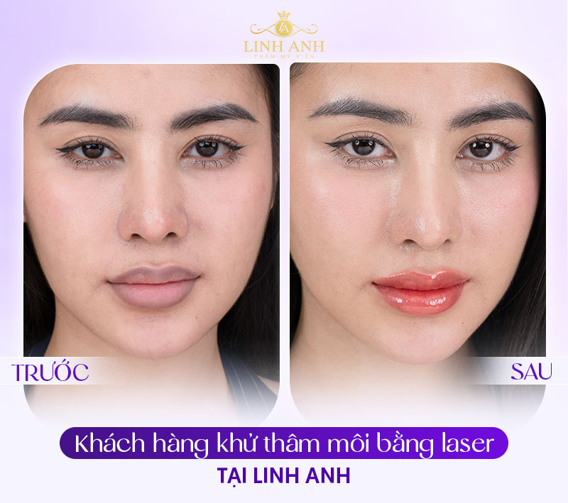 khử thâm môi kiêng nước bao lâu là tốt khử thâm môi kiêng nước bao lâu là tốt