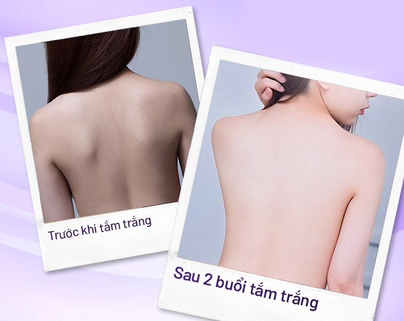 làm trắng glubel bao nhiêu tiền