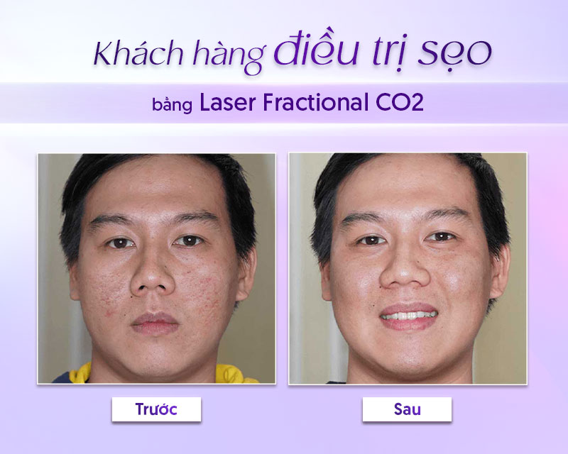laser co2 fractional giá laser co2 fractional giá