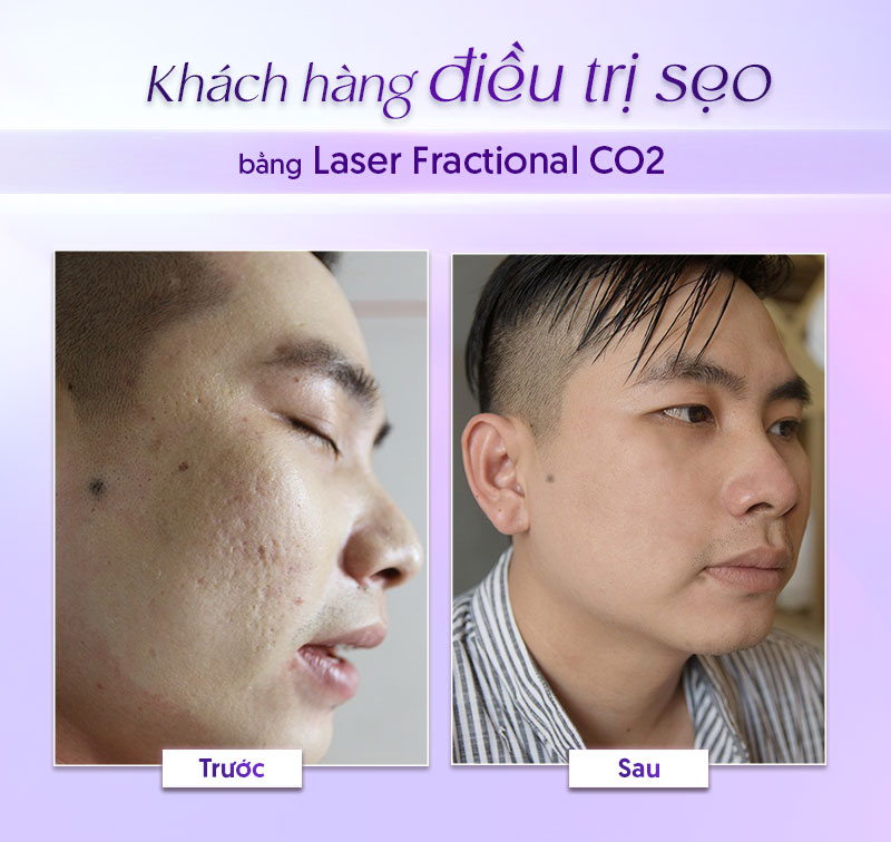 laser fractional giá laser fractional giá