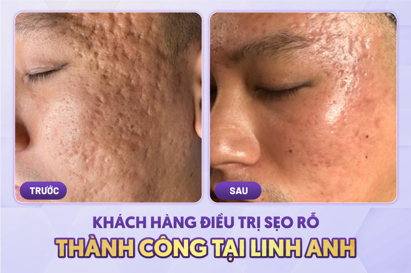 liệu trình cắt đáy sẹo rỗ bao nhiêu