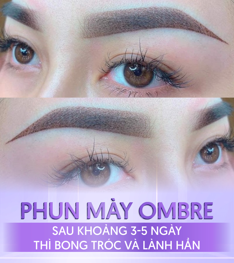 phun mày ombre sau khi bong - Viện thẩm mỹ quốc tế Linh Anh