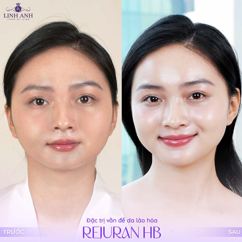 Đặc trị vấn đề lão hóa da Rejuran HB