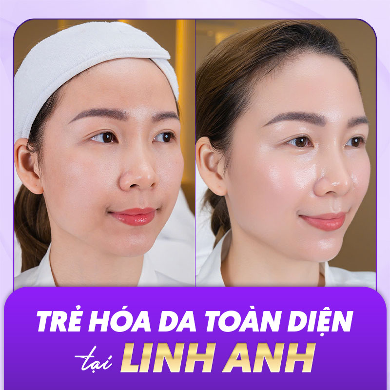 trẻ hoá da mặt bao nhiêu tiền