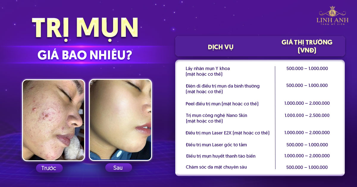 trị Mụn giá bao nhiêu