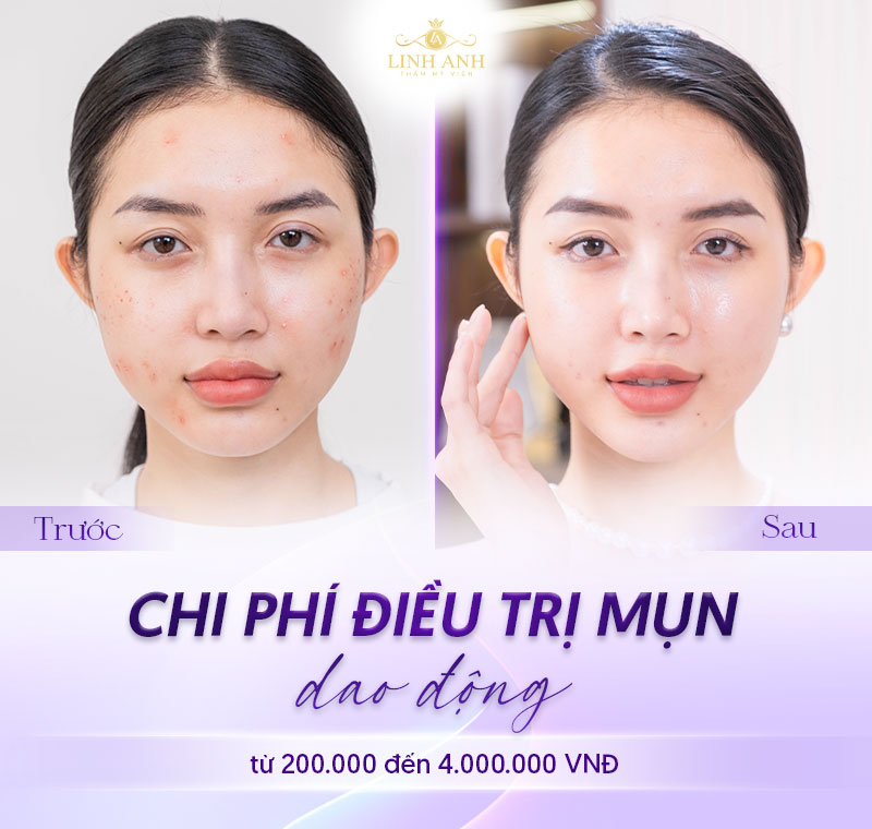 trị Mụn vĩnh viễn giá bao nhiêu trị Mụn vĩnh viễn giá bao nhiêu