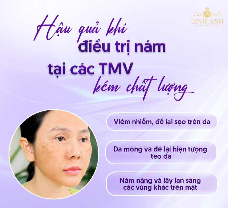 Trị nám thẩm mỹ Linh Anh gò vấp - Viện thẩm mỹ quốc tế Linh Anh