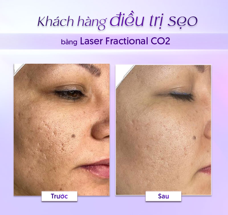 trị sẹo rỗ bằng laser co2 giá bao nhiêu trị sẹo rỗ bằng laser co2 giá bao nhiêu