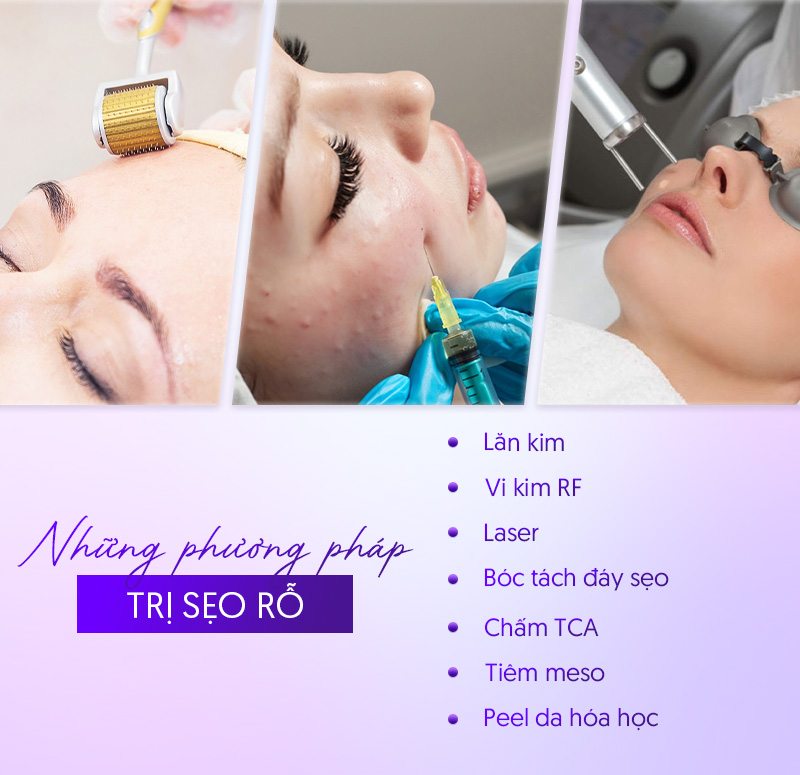 trị sẹo rỗ hiệu quả tại Linh Anh