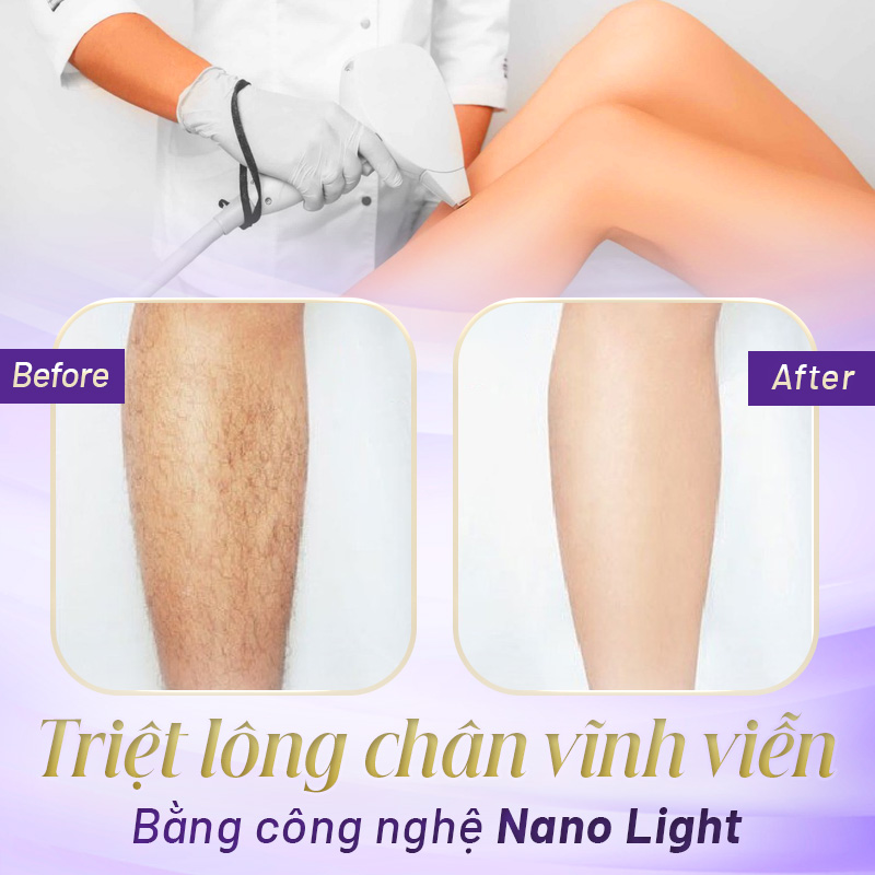 triệt lông vĩnh viễn là sao