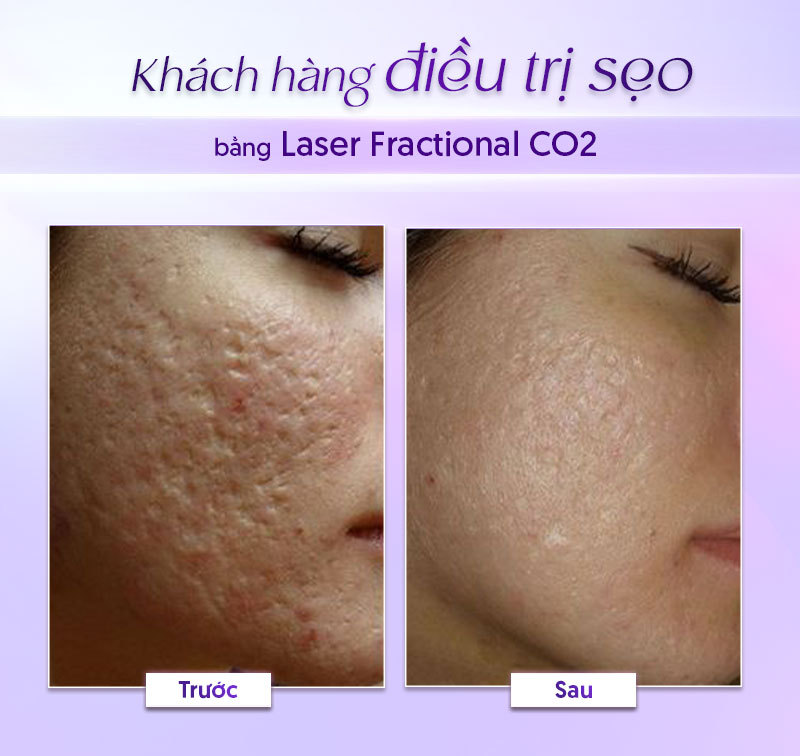 xóa sẹo bằng laser bao nhiêu tiền xóa sẹo bằng laser bao nhiêu tiền