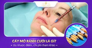 Cấy mỡ rãnh cười