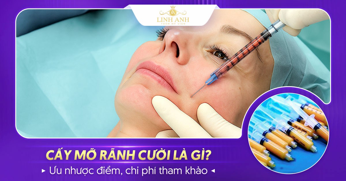 Cấy mỡ rãnh cười: Bí quyết cho nụ cười rạng rỡ không nếp nhăn