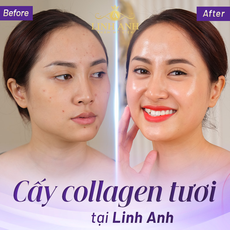 cấy Collagen tươi hiệu quả