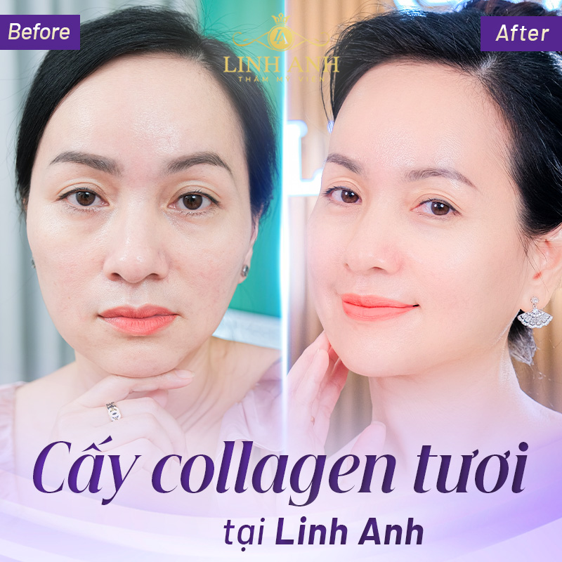 cấy Collagen tươi ở đâu