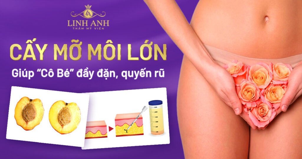 cấy mỡ môi lớn