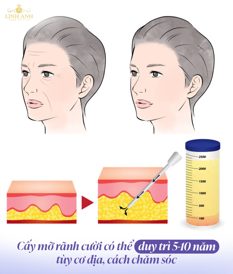 Cấy mỡ rãnh cười được bao lâu