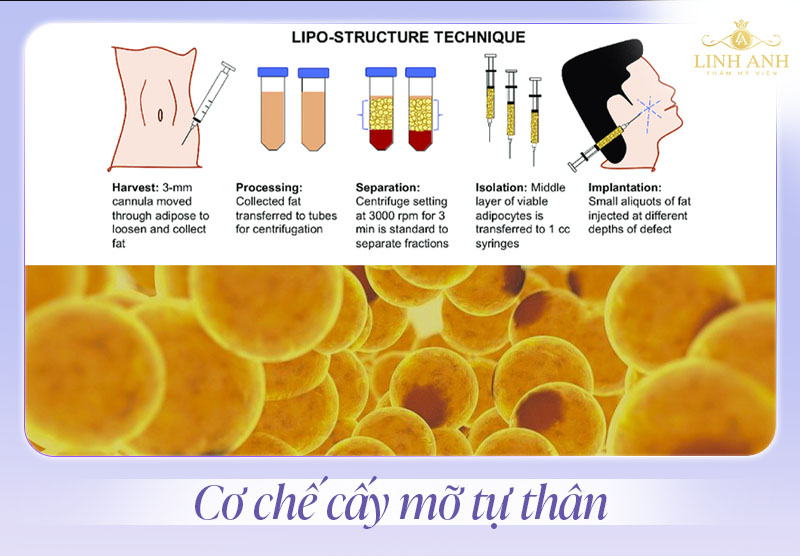 Cấy mỡ tự thân rãnh cười