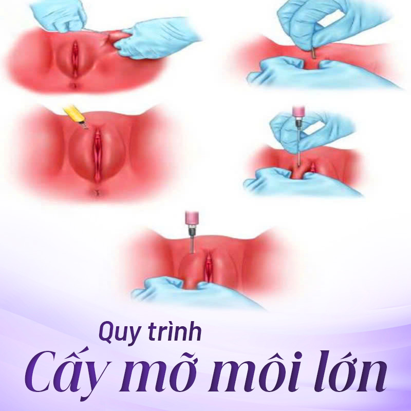 dịch vụ cấy mỡ môi lớn