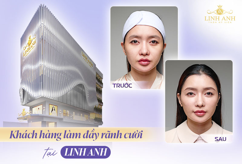 Hình ảnh trước sau cấy mỡ vào rãnh cười