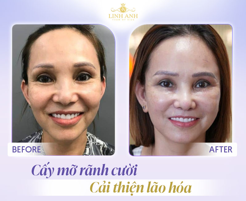 review cấy mỡ rãnh cười