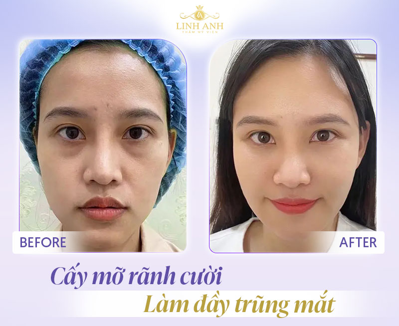 review cấy mỡ rãnh mũi má