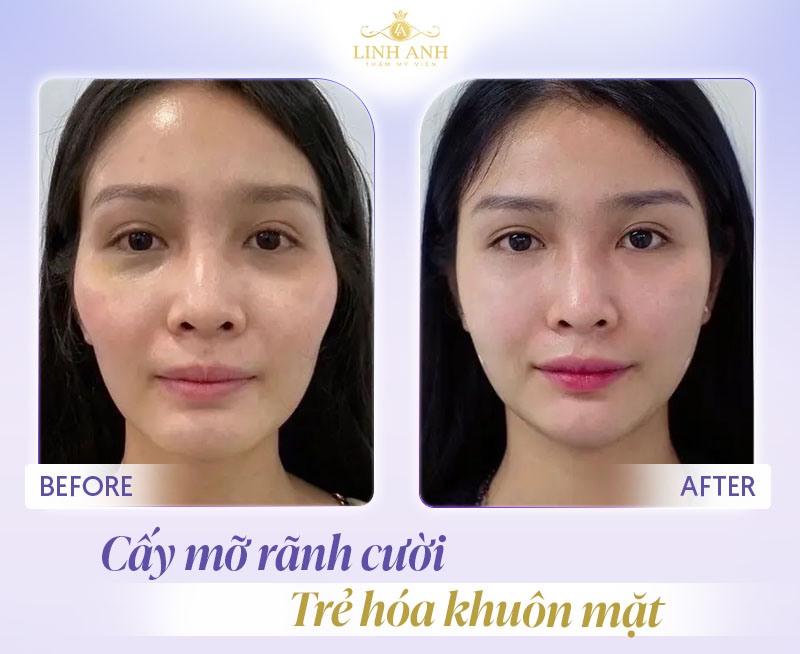 review cấy mỡ tự thân rãnh cười