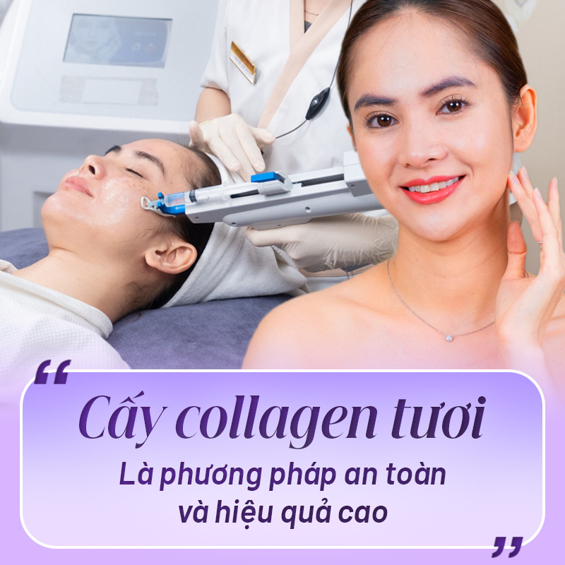 tìm hiểu về cấy Collagen tươi