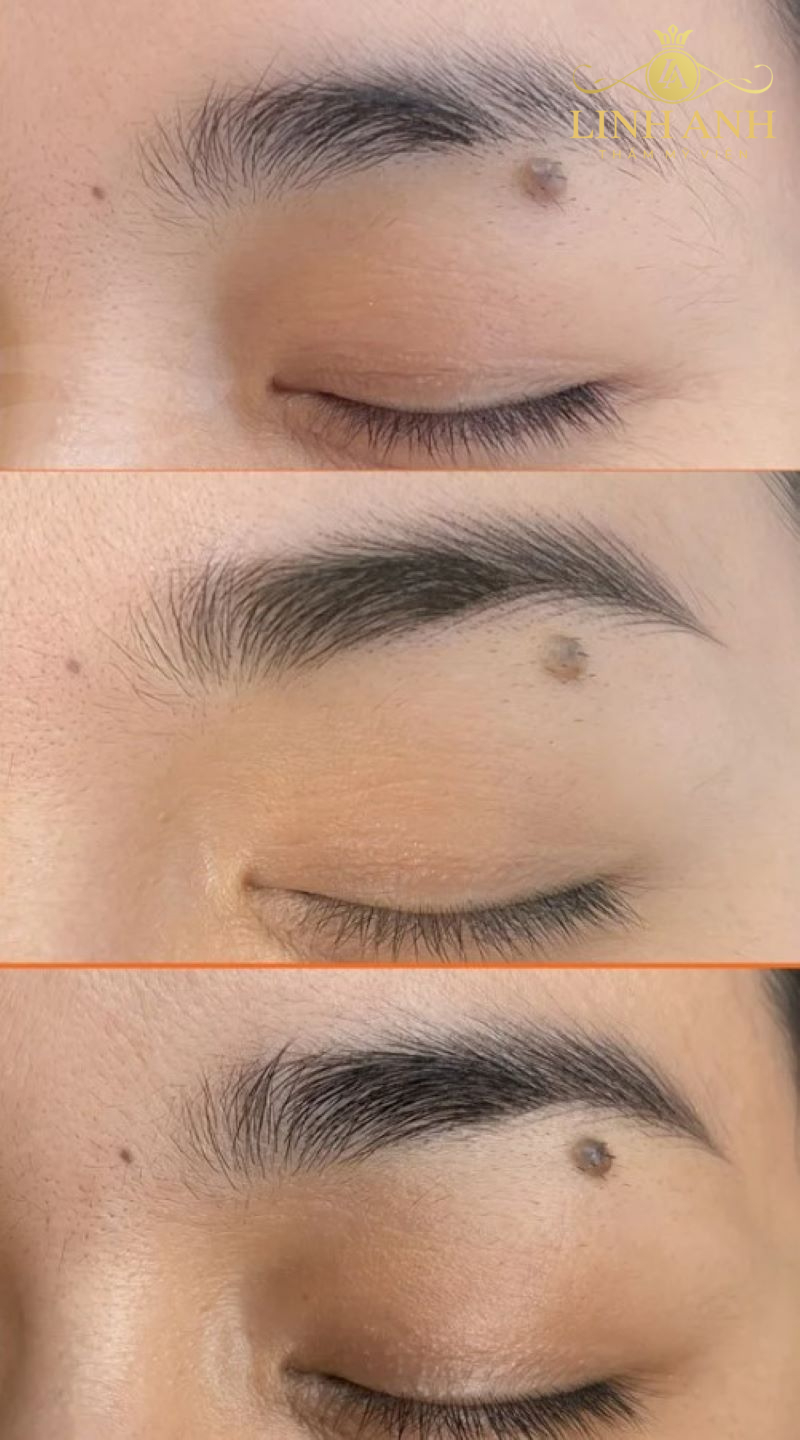 ảnh chân mày trước và sau khi bong thực tế ảnh chân mày trước và sau khi bong thực tế