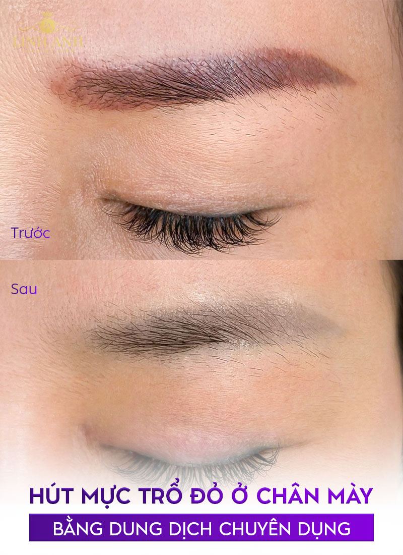 cách xử lý chân mày trổ xanh cách xử lý chân mày trổ xanh