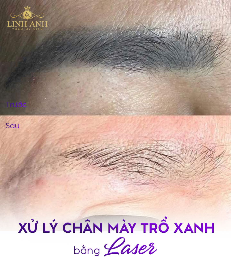 chân mày trổ xanh chân mày trổ xanh