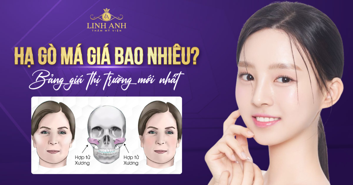 hạ gò má bao nhiêu