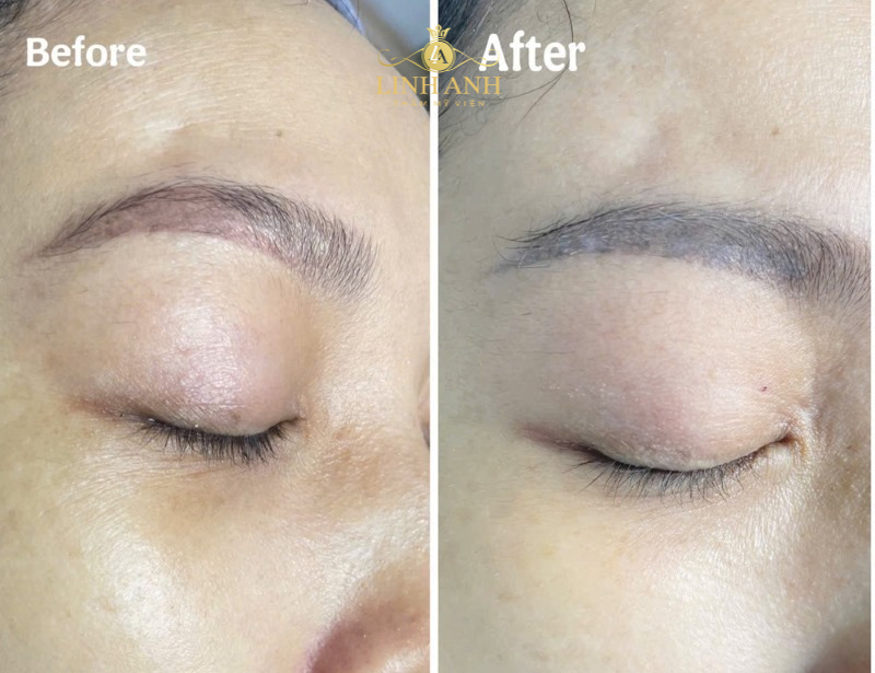 hình ảnh sau khi xóa xăm lông mày bằng laser hình ảnh sau khi xóa xăm lông mày bằng laser
