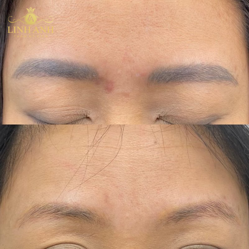 hình ảnh sau khi xóa xăm mày bằng laser hình ảnh sau khi xóa xăm mày bằng laser