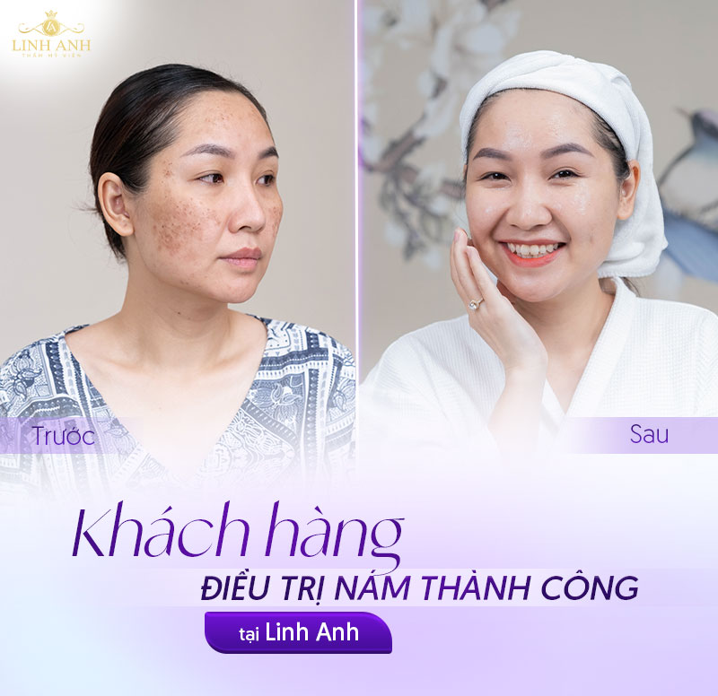 khach hang sau 4 buoi tri nam bang laser
