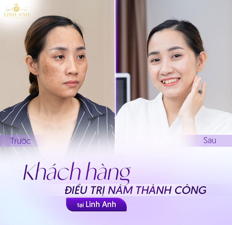 Khách hàng sau 3 buổi điều trị nám
