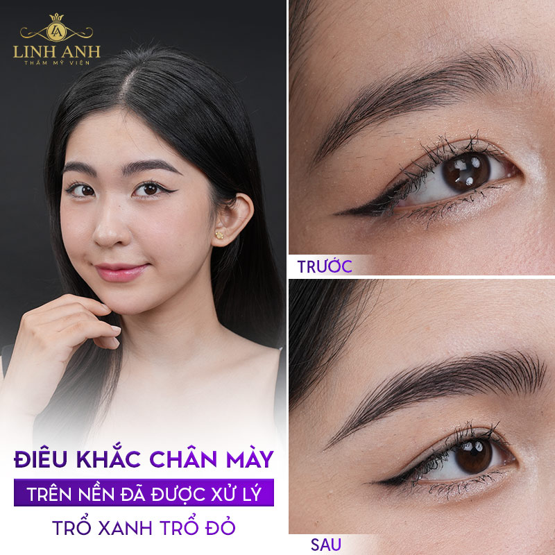 lông mày bị trổ xanh lông mày bị trổ xanh