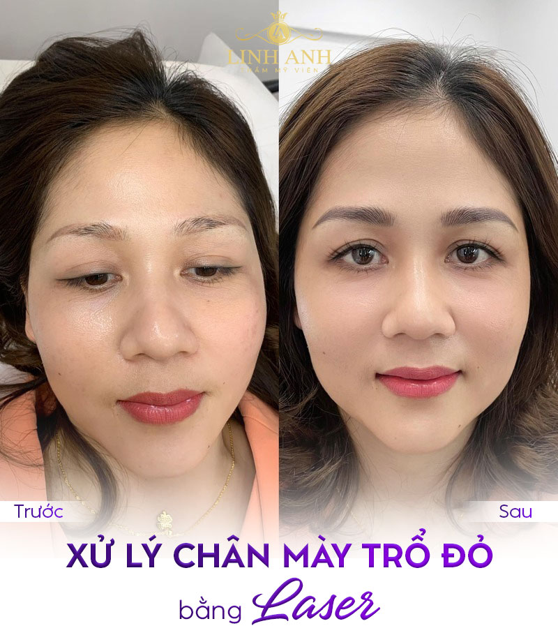 lông mày trổ đỏ lông mày trổ đỏ